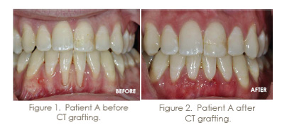 trammell periodontics grafting