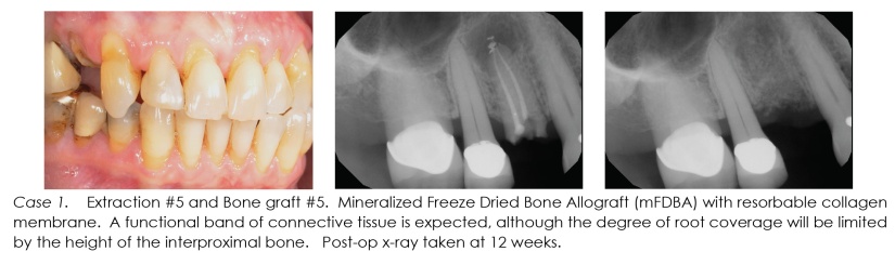 periodontal surgery guided bone regeneration